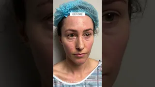 Trifecta Lift After Dissolving Tear Trough Filler with Dr. Kami Parsa | 1 Month Post-op