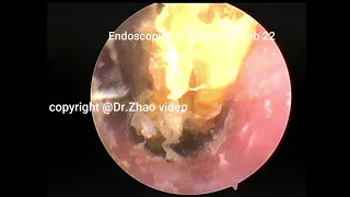 Satisfying Removal With Dry piece cleaning, 11 minutes