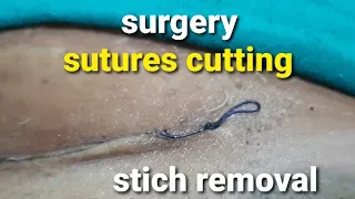 Stiches removal and dressing after cesarean section || घुलनशील टाँको को काटना || suture removal