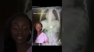 Baby swallowed a coin! What we do next 🧐