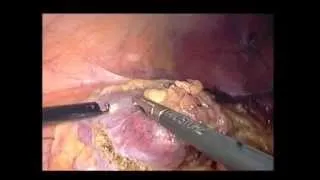 Laparoscopic Partial Nephrectomy