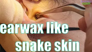 earwax like snake skin | Earwax peels off like snake skin and is very itchy | ear wax cleaning |