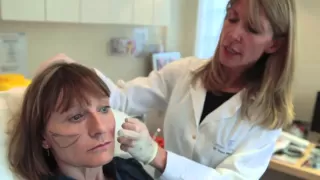 Non-surgical facelift (the Y-Lift) with Restylane Sub-Q Dermal filler | The Cosmetic Skin Clinic