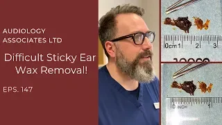 DIFFICULT STICKY EAR WAX REMOVAL - EP 147