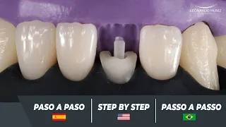 Carilla con resinas y postes en incisivo inferior / Veneer with resins and posts on lower incisor