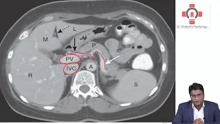Identifying Abdominal vessels on Axial CT scan