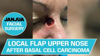 LOCAL FLAP UPPER NOSE AFTER BASAL CELL CARCINOMA - DR. TANVEER JANJUA - NEW JERSEY