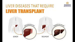 Liver Transplant Cost in Hyderabad, India | Liver Diseases That Require Liver Transplant