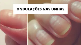 O QUE CAUSA ONDULAÇÕES NAS UNHAS | #rafatododia