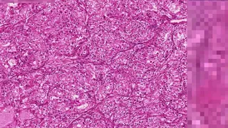 Hypernephroma (RCC) Histopathology - Madeformedical.com