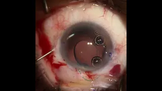 Traumatic crystalline lens dislocation and mydriasis repair