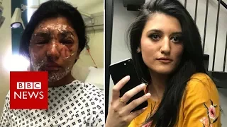 Acid survivor pities her attacker - BBC News