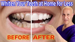 Whiten Your Teeth at Home for Nearly Free!  Dr. Mandell