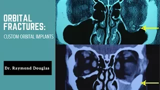 Orbital Trauma and Customized Implant | Dr. Raymond Douglas, MD, PhD