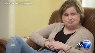 Youngest face transplant recipient in U.S. history