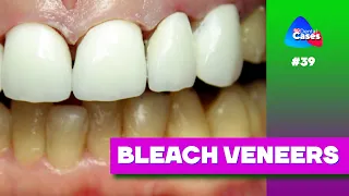 Bleach veneers | BG Dental Cases #39