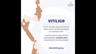 The fundamentals of vitiligo: A long-term skin condition.