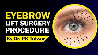 Eyebrow Lift Surgery in Delhi, Forehead Lift Surgery, Endoscopic Brow Lift Surgery by Dr. PK Talwar