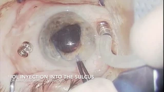 Luxación de Núcleo en Catarata Traumática- Traumatic Cataract Luxation of Nucleus