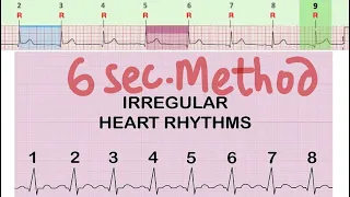 ECG-Heart Rate Calculation in Irregular Rhythm , 6 second Method