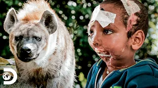Reconstrução da mandíbula de menino atacado por hiena | Meu Corpo, Meu Desafio | Discovery Brasil