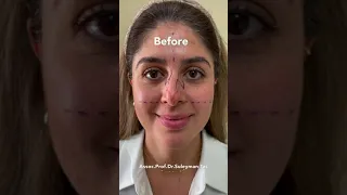 Real Rhinoplasty Experience | Clinic - Hospital - Cast Removal Day