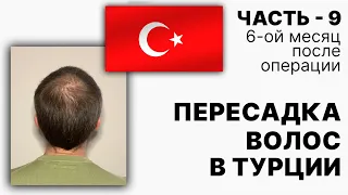 Пересадка волос в Турции. Часть-9(6-ой месяц после операции)