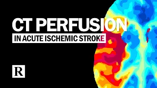 CT Perfusion In Acute Ischemic Stroke