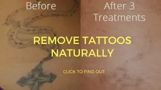 How To Remove Tattoos Naturally
