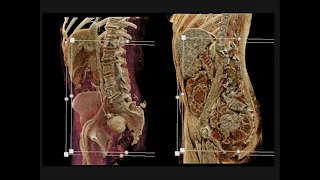 CT Evaluation of GI Bleeding Part 2