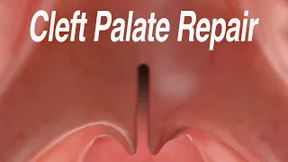 Cleft Palate Repair: Furlow Palatoplasty Technique