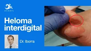 Heloma Interdigital u Ojo de Gallo | Podología Dr. Iborra