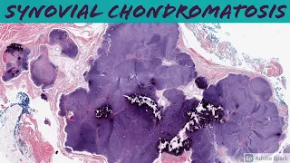 Synovial Chondromatosis: 5-Minute Pathology Pearls