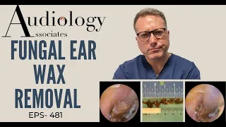 FUNGAL EAR WAX REMOVAL - EP481