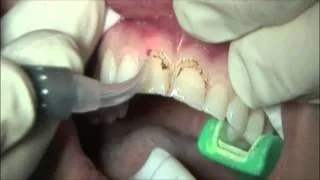 Laser stomatologiczny NV Microlaser - likwidacja przerostu dziąsłowego (gingivectomy)