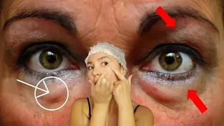 How to get rid of PUFFY EYES | Get rid of EYE BAGS fast