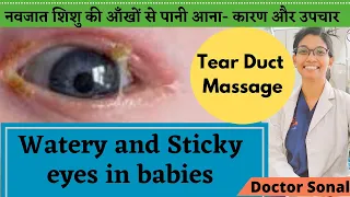 Watery and sticky eyes in babies | causes and Treatment| Tear Duct Massage| Doctor Sonal