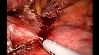 Cancer Of The Body Of Pancreas Techniques For Laparoscopic Distal Pancreatectomy In The Setting Of S