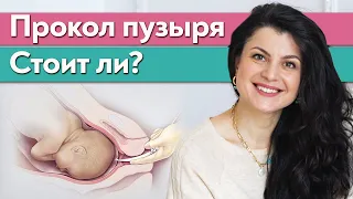 Как прокалывают околоплодный пузырь? | Что такое амниотомия?