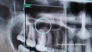 PaX i Insight Clinical Case