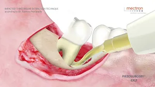 PIEZOSURGERY® - impacted third molar extraction technique according to Dr. Fabrizio Fontanella