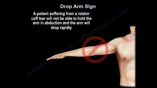 Drop Arm Sign, rotator cuff tear.