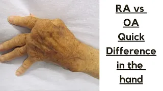 Rheumatoid arthritis vs Osteoarthritis-Brief difference you can see in the hands