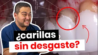 ¿CARILLAS DENTALES SIN DESGASTE? ¡PUES NO! ¡CUIDADO con OFERTAS ENGAÑOSAS!