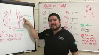 ELECTROCARDIOGRAMA EN INFARTO AL MIOCARDIO