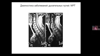 Лекция: Хирургическое лечение стеноза трахеи