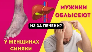 90% людей с проблемами ПЕЧЕНИ не знают об этом. 14 ранних признаков того, что ваша печень умирает