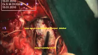 MENINGIOMA BRAIN-LARGE TEMPORAL BASAL-microsurgery-dr suresh dugani/HUBLI /KARNATAK/INDIA