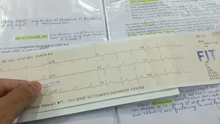 #Informational video regarding normal ECG# ECG कैसे देखते हैं# ECG रिपोर्ट सभी डाउट क्लियर करें।