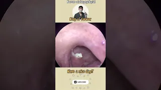 @귀지형 #편도 #편도결석 #편도결석제거 #목청소 #이비인후과 #tonsil #tonsilstonremoval  #asmr